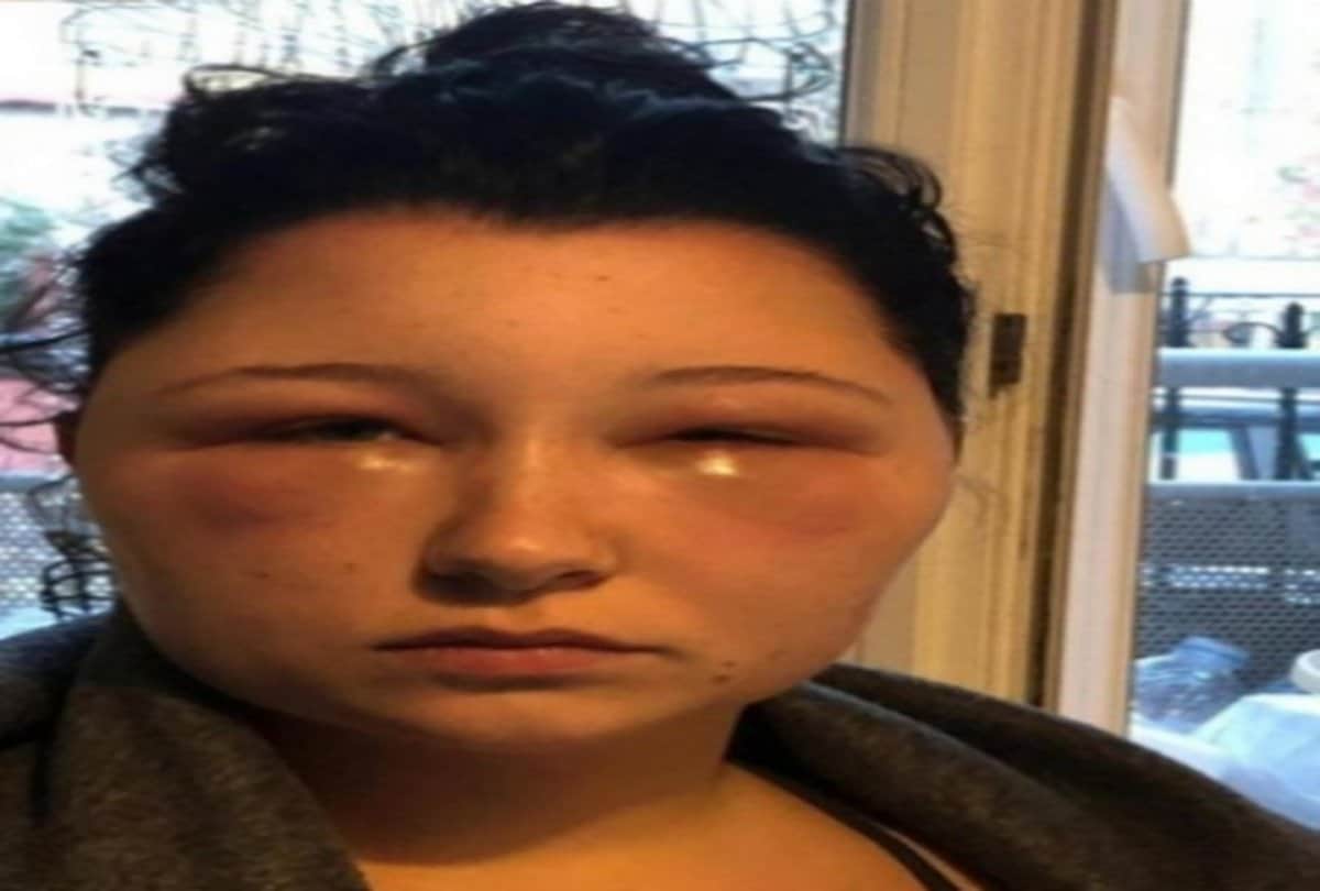 viral story france girl do hair dye which result allergic to her and head size becomes double