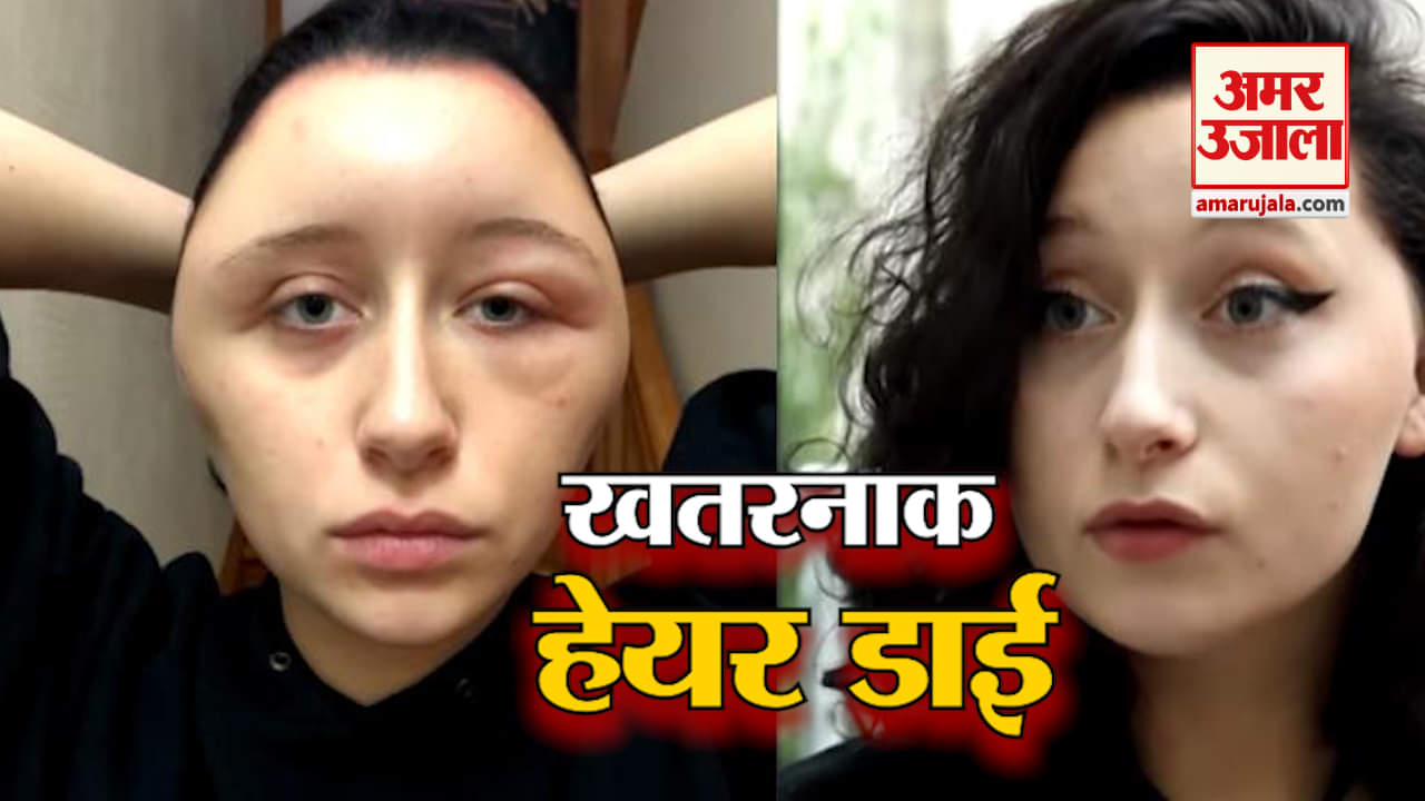 आकर्षित दिखने के लिए लगाई थी हेयर डाई, लेकिन हो गया ये हाल