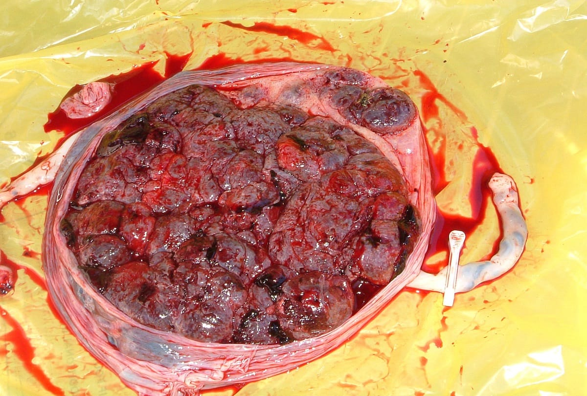 Woman Earns 7.5 Lakhs Rs. a Year from Medical Waste Placenta, Making Many Products