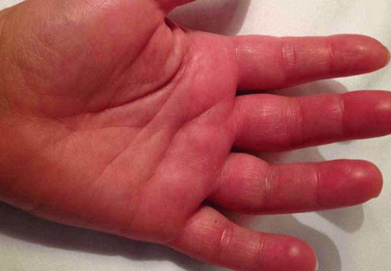 Tips to Avoid Cold Soreness