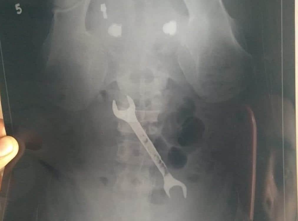 BHU hospital doctors found rinch in Stomach of patient