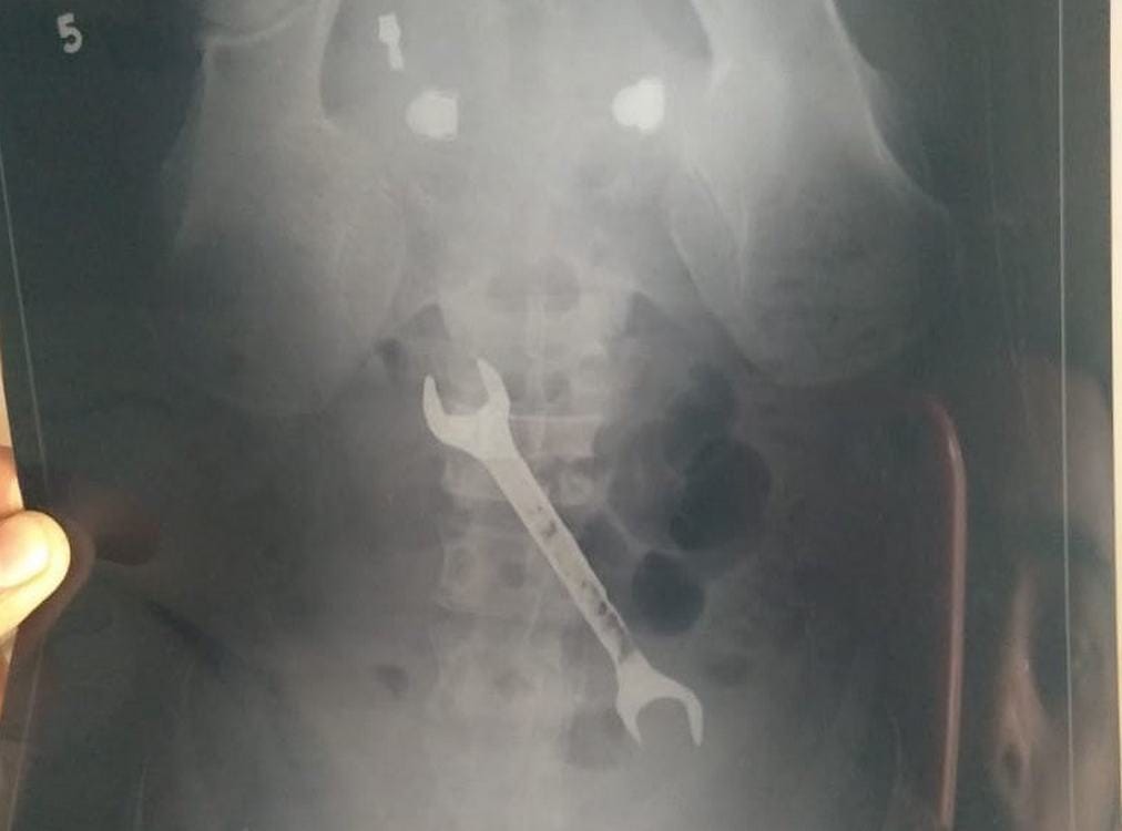 BHU hospital doctors found rinch in Stomach of patient