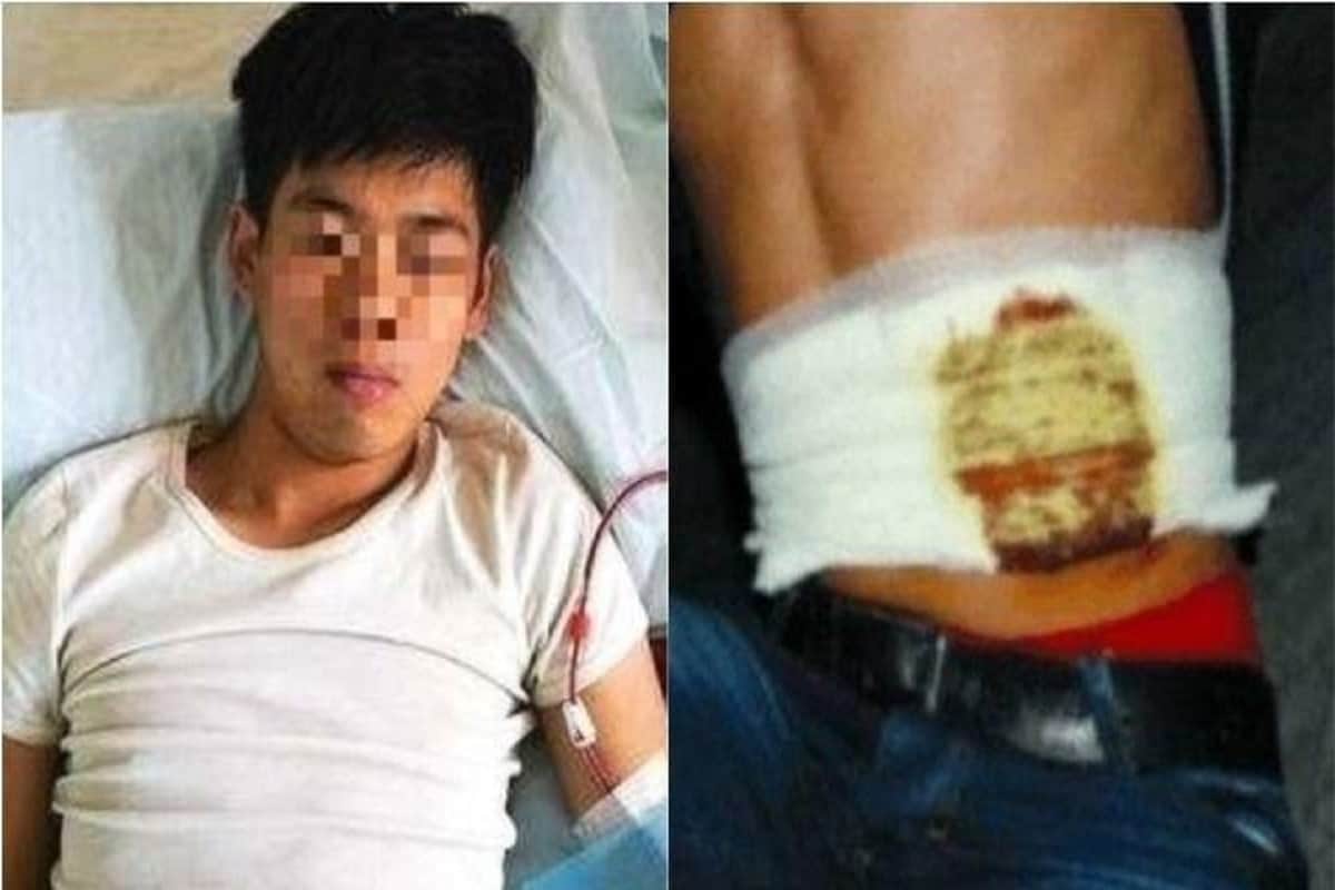 17 year old boy sold his kidney for an iPhone 4, now is bed-ridden for life