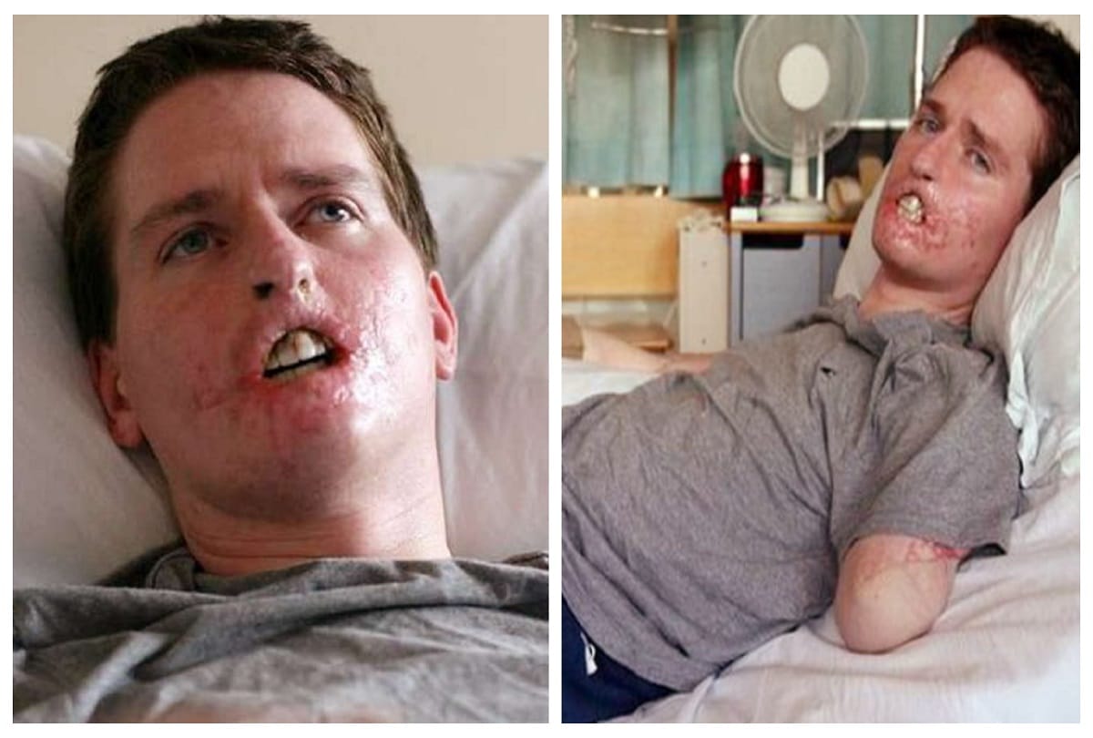 man loses His three important limbs after common cold in England 