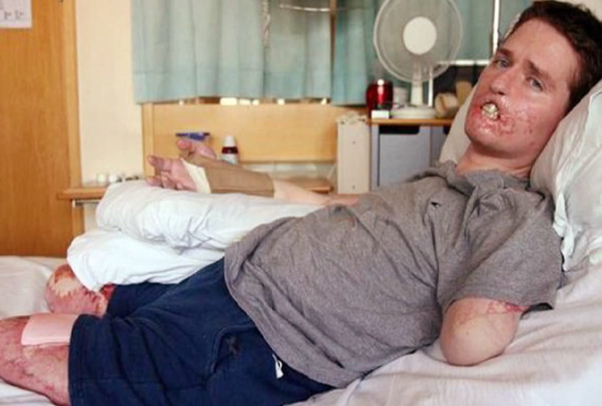 man loses His three important limbs after common cold in England 