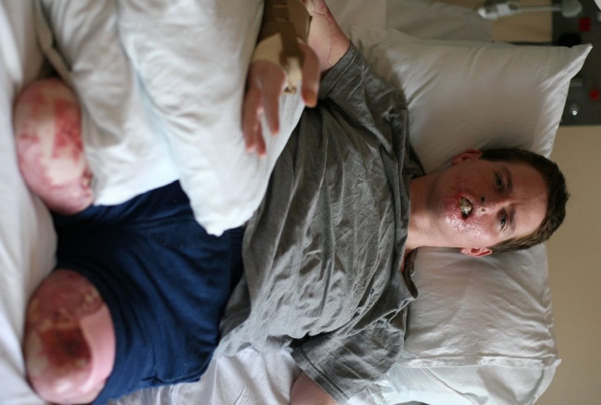 man loses His three important limbs after common cold in England 