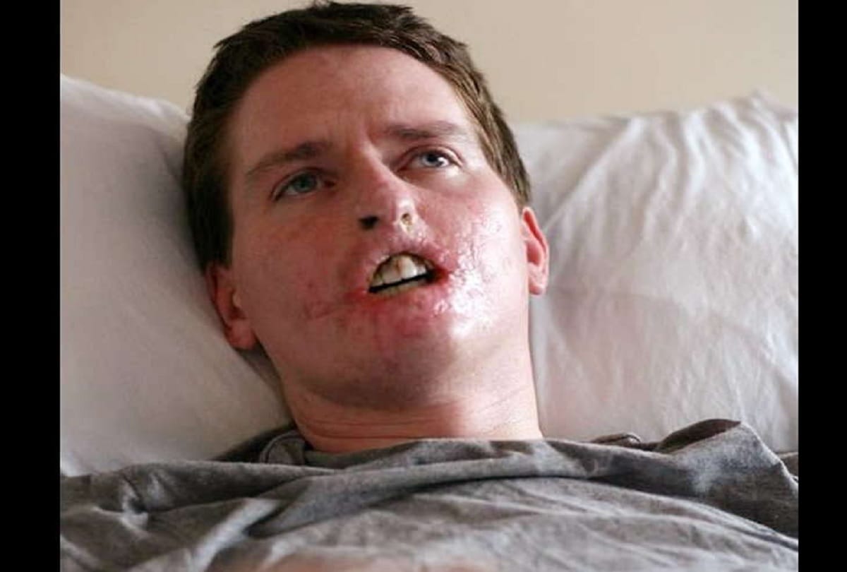 man loses His three important limbs after common cold in England 