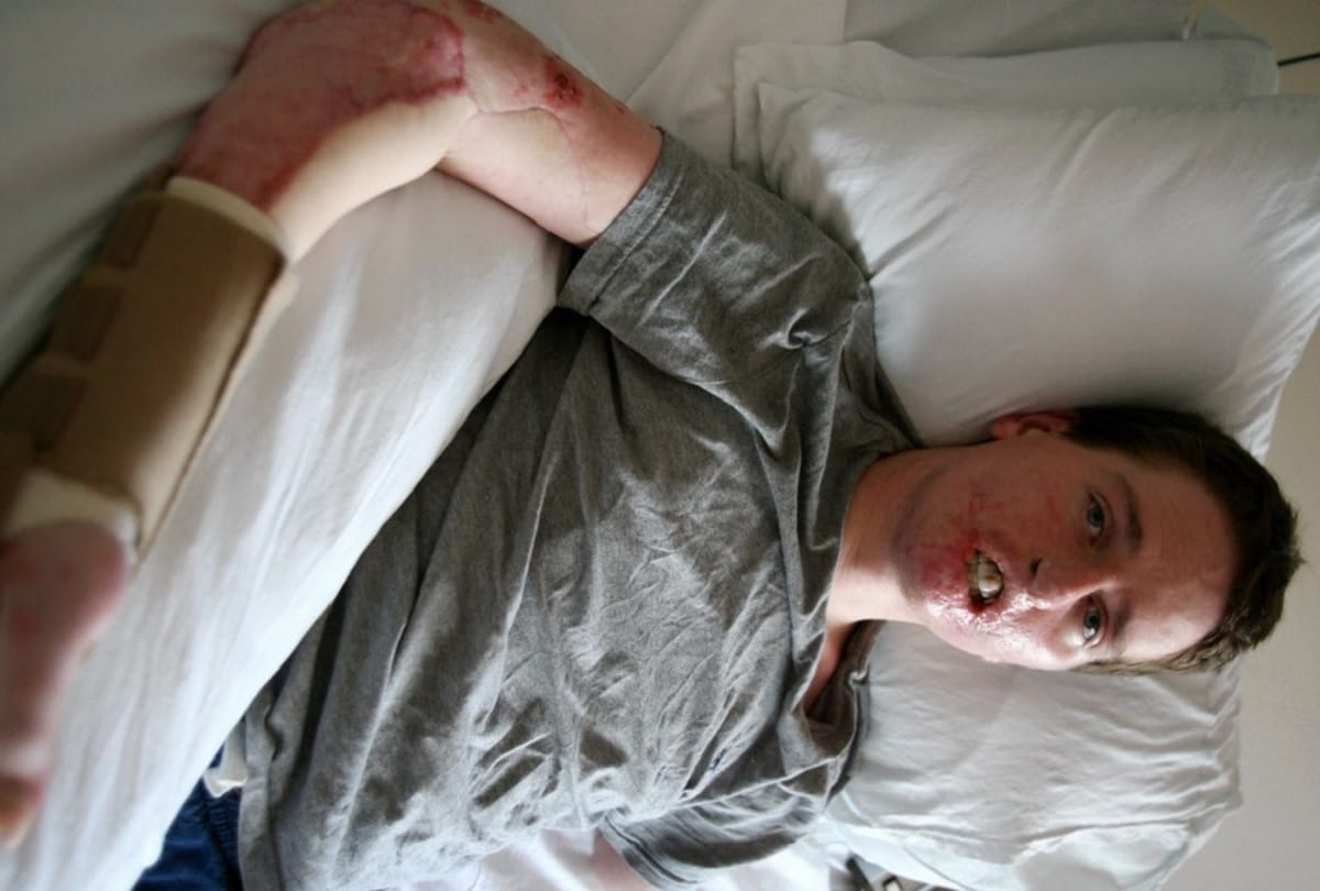 man loses His three important limbs after common cold in England 