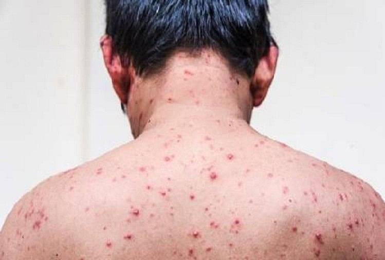 22-people-in-sidharijot-vulnerable-to-chicken-pox-disease-in-basti