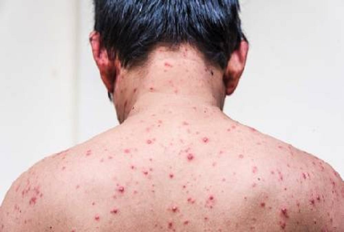 Chicken Pox spread in the village of Lakhimpur Kheri one dies