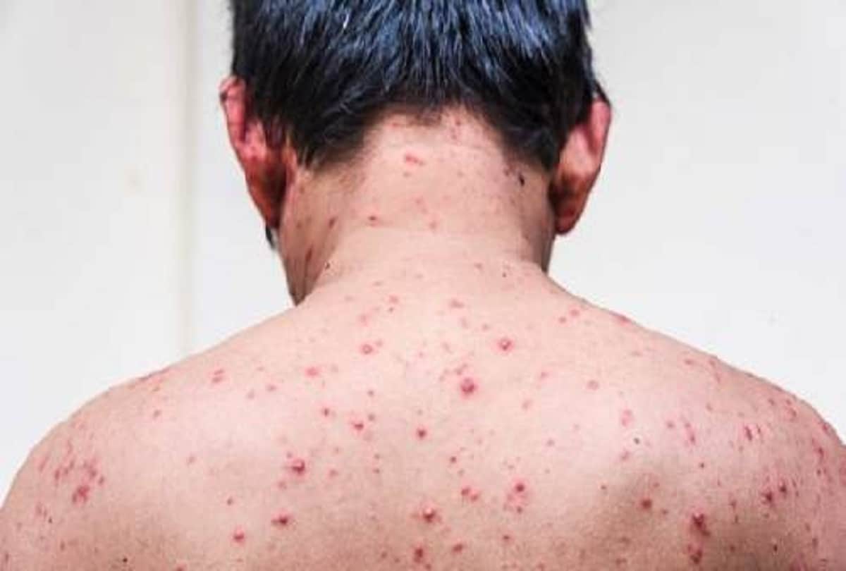 monkeypox outbreak in european countries, UK patients have different symptoms, study finds