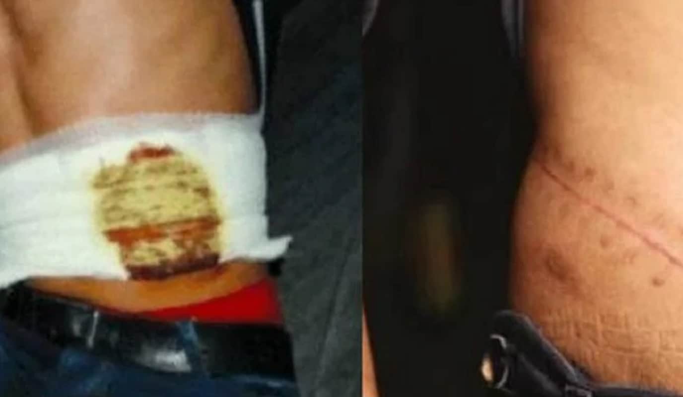 China: teenager sells kidney for iphone, second kidney also failed due to infection
