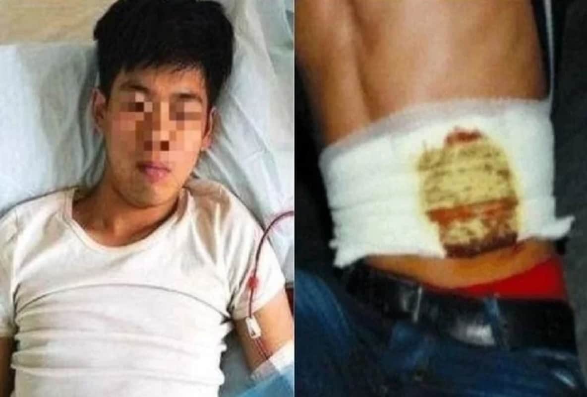 China: teenager sells kidney for iphone, second kidney also failed due to infection