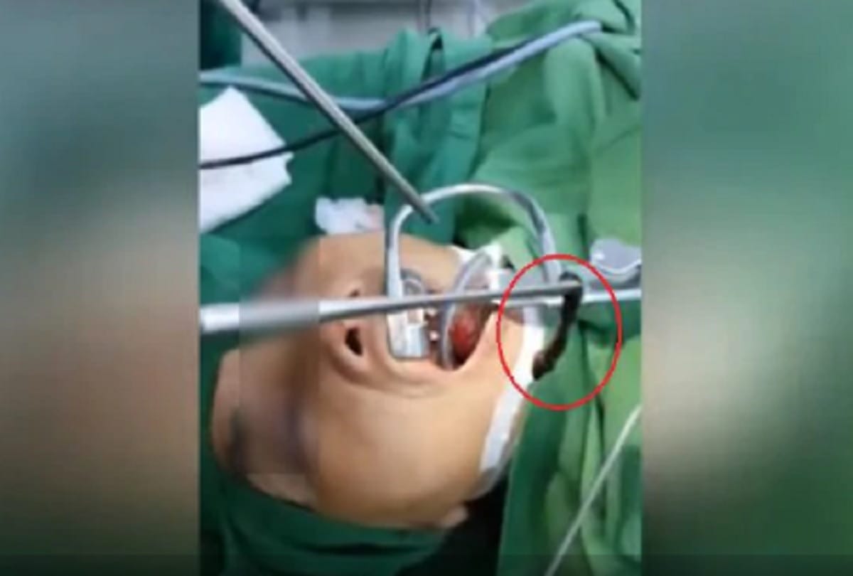 surgeons remove two inch live leech from womans throat video goes viral