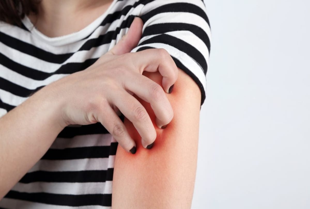 home remedies for ringworm eczema itching treatment with this flower in seven days