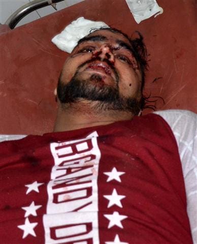 Petrochemicals in Barracks and non-community in Upkot, many injured