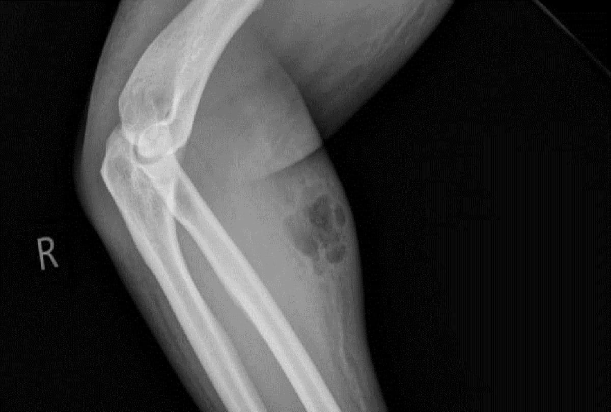 osteoporosis causes symptoms and prevention, all you want to know about this diseases