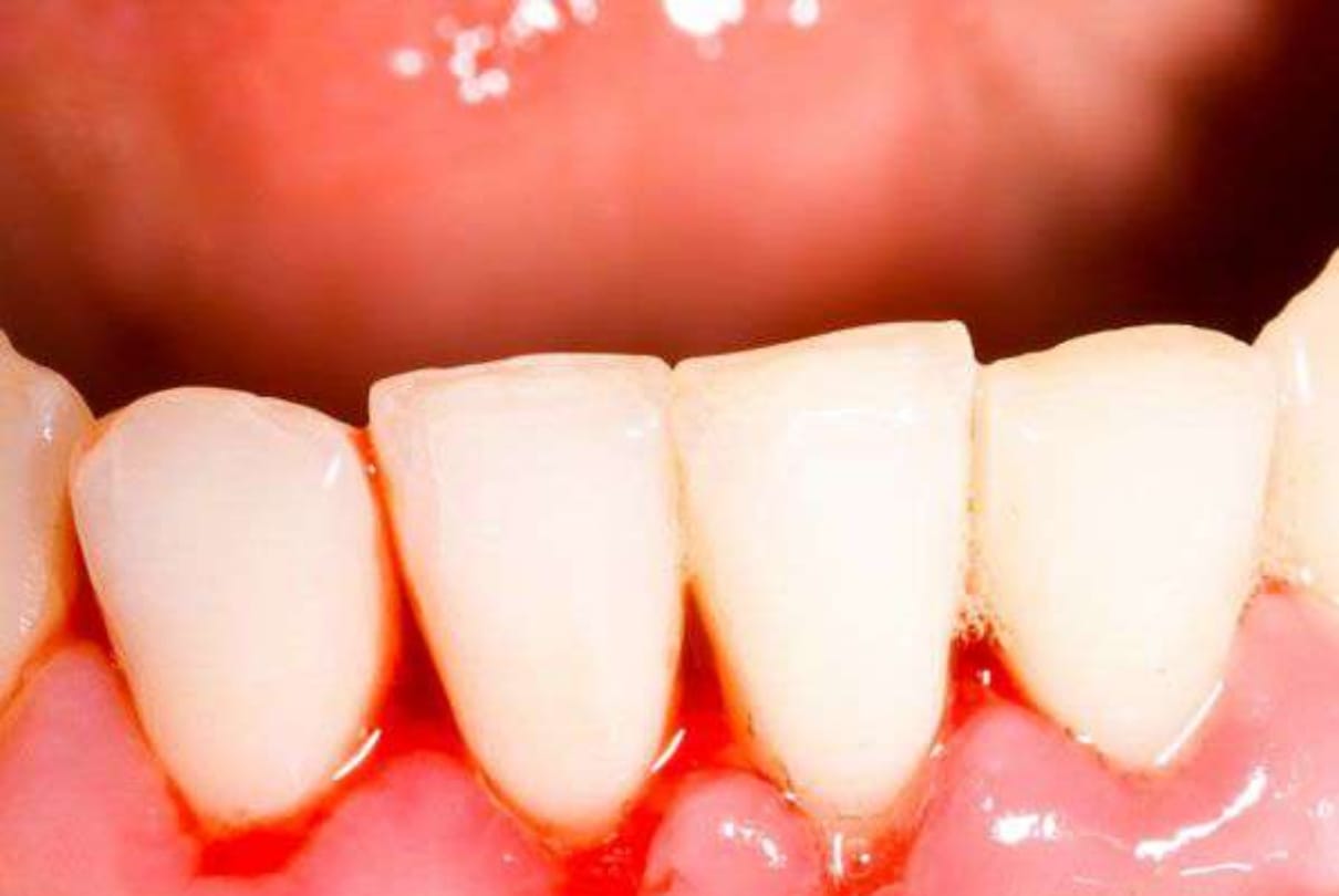 know about the problems die to exceeding of heamoglobin