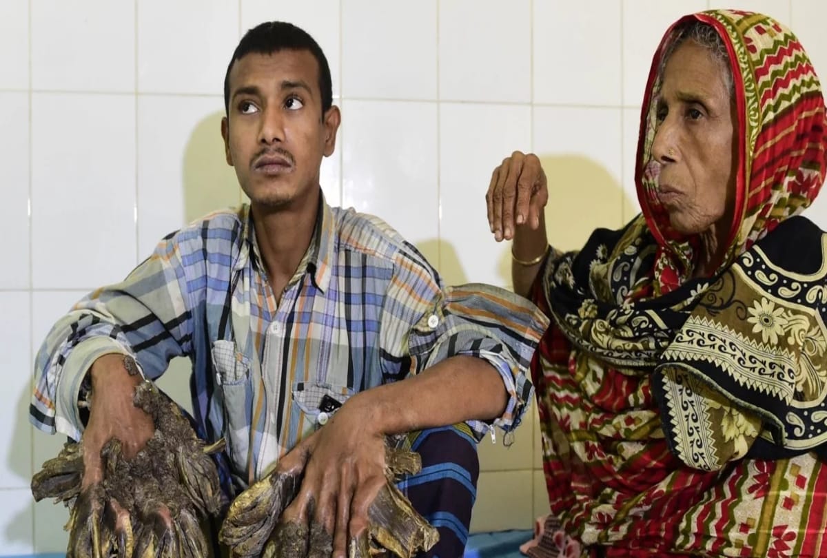 bangladesh's 'tree man' returns for more surgery after rare condition