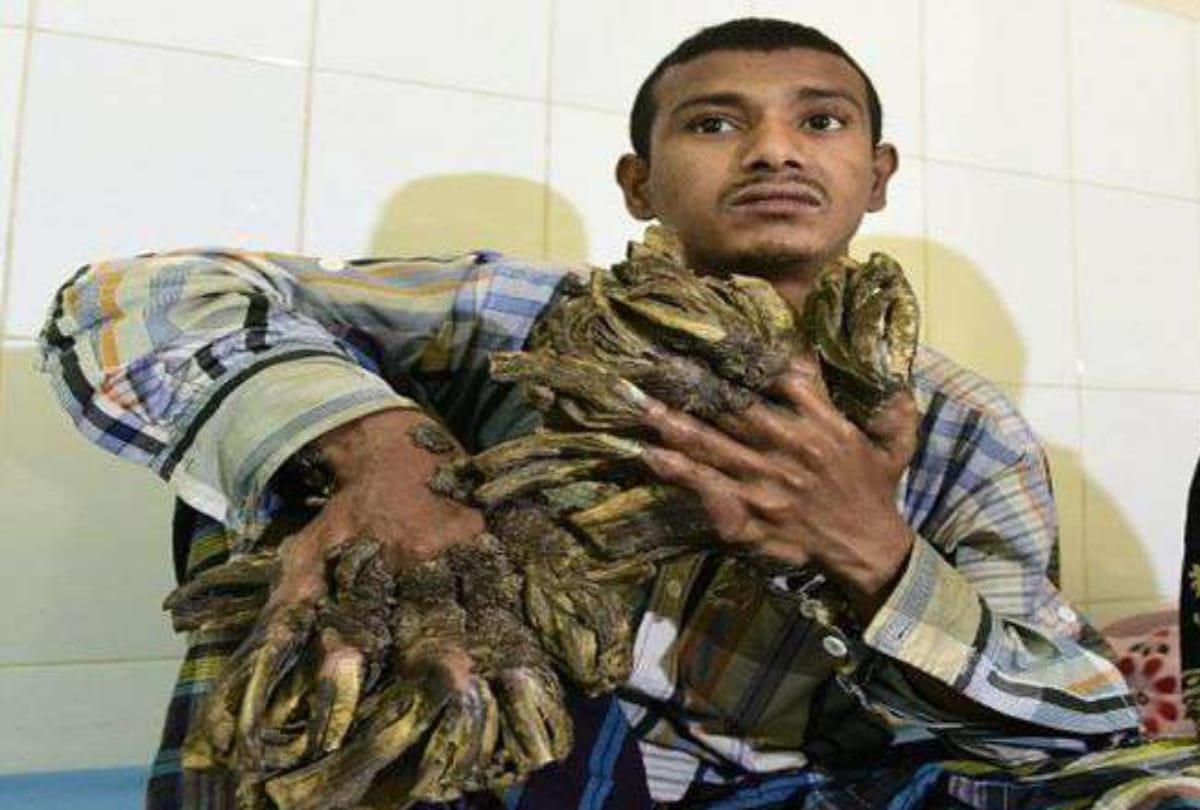bangladesh's 'tree man' returns for more surgery after rare condition