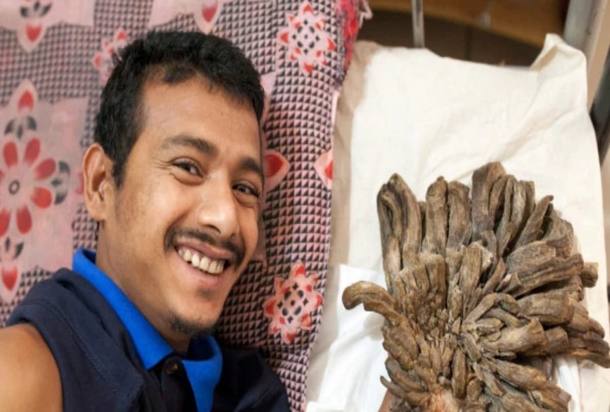bangladesh's 'tree man' returns for more surgery after rare condition