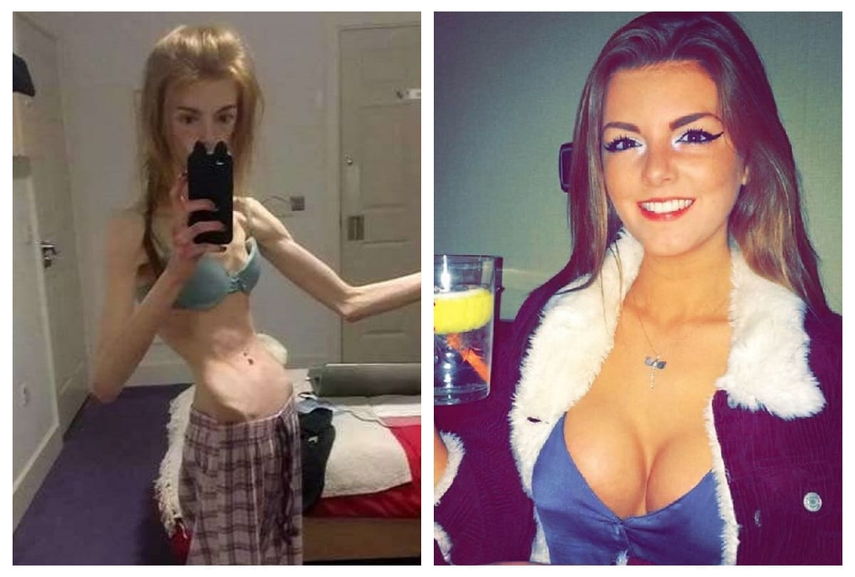 England girl Annie windley body weight was low abnormally because of Anorexia