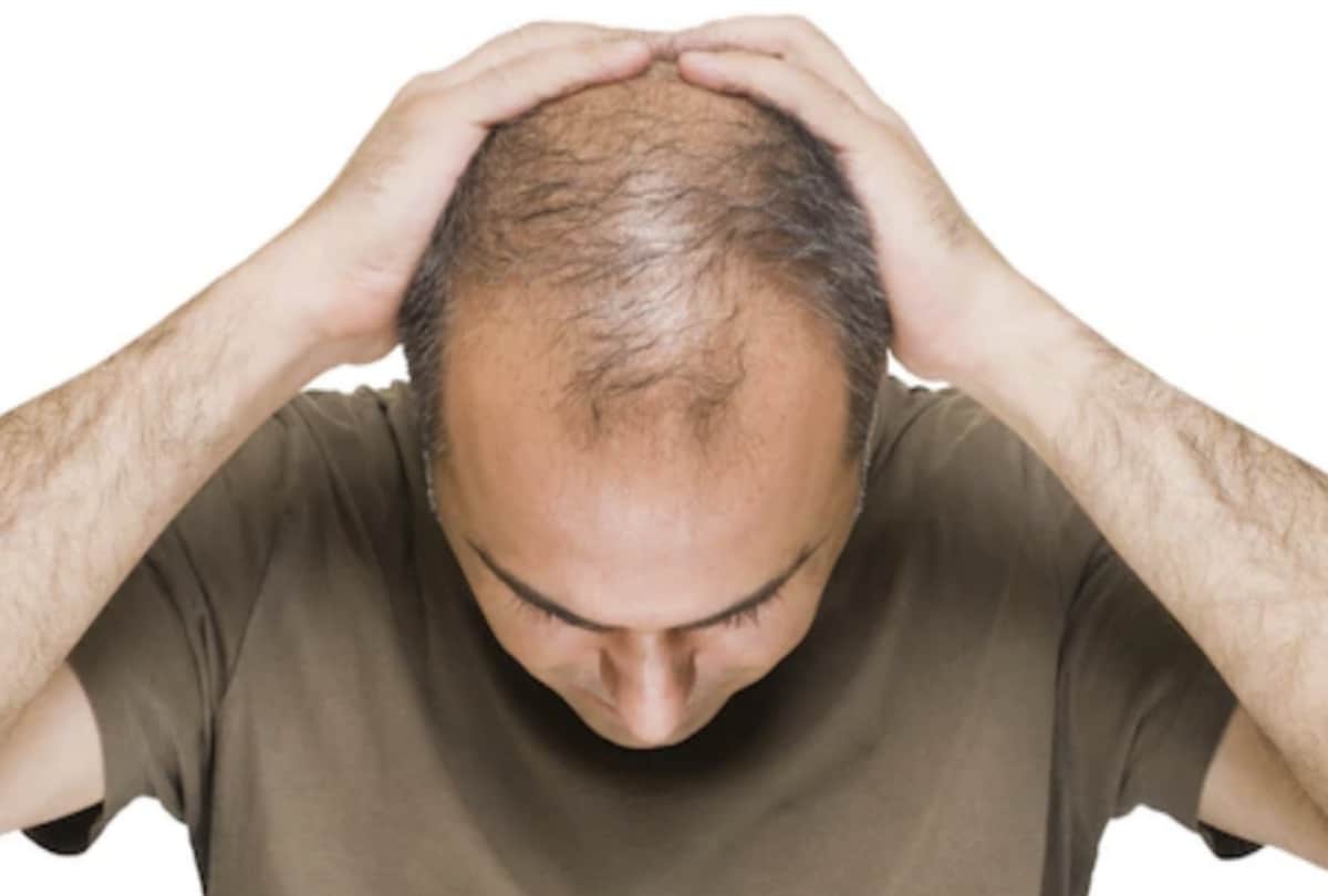 hair loss in patches is sign of baldness