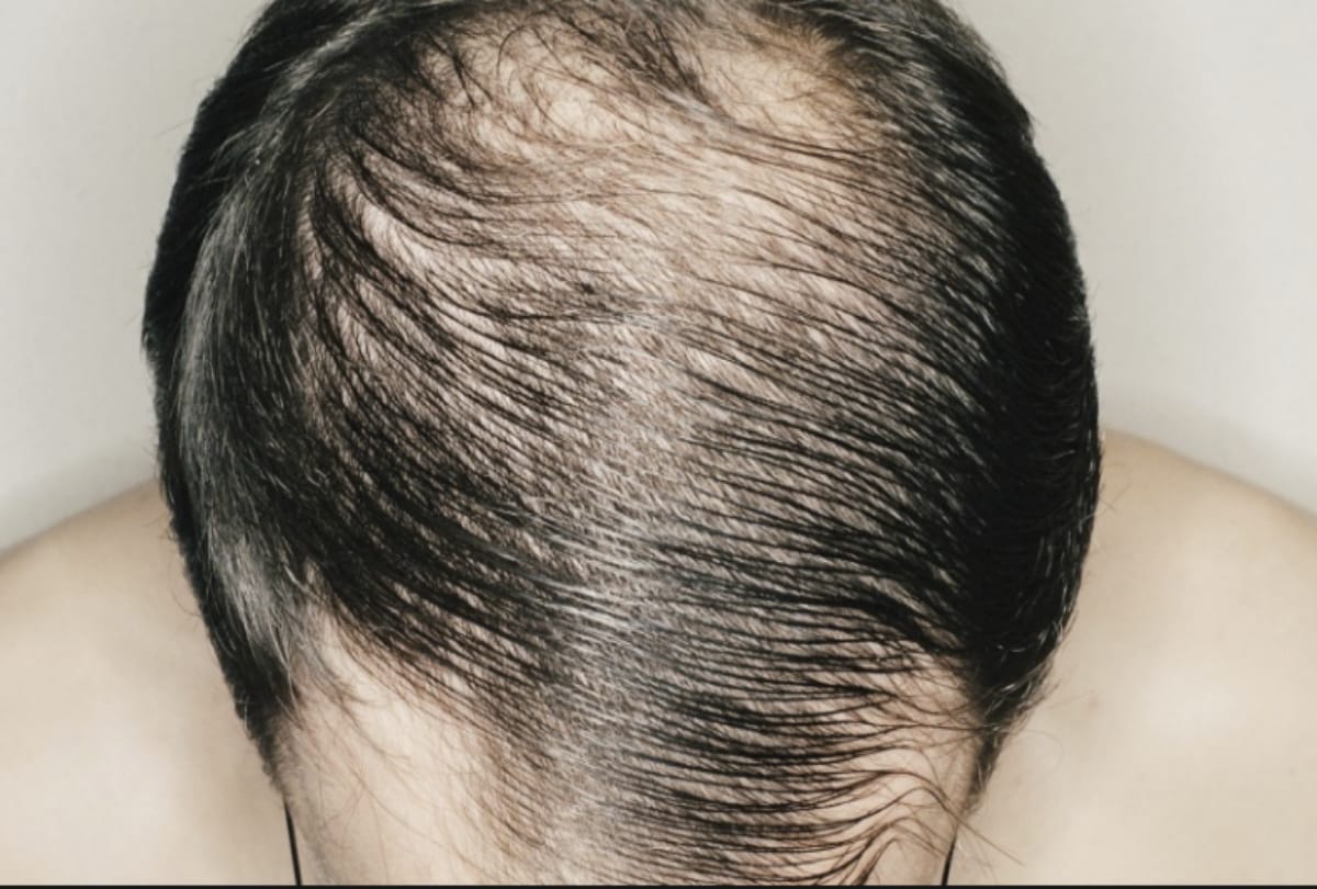 Post Covid patients hair fall even after two years