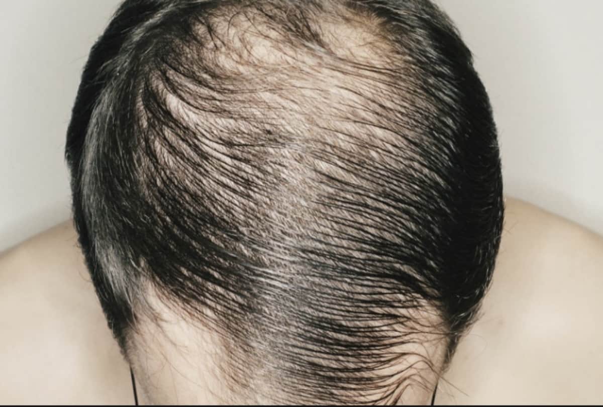 Patients suffering from telogen effluvium due to mental stress after recovering from corona