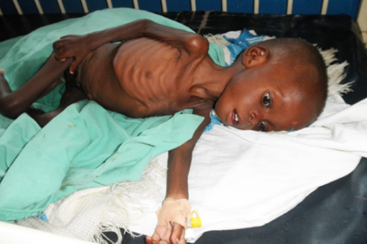 severe malnourished 15 month child found in Indore by Child Line