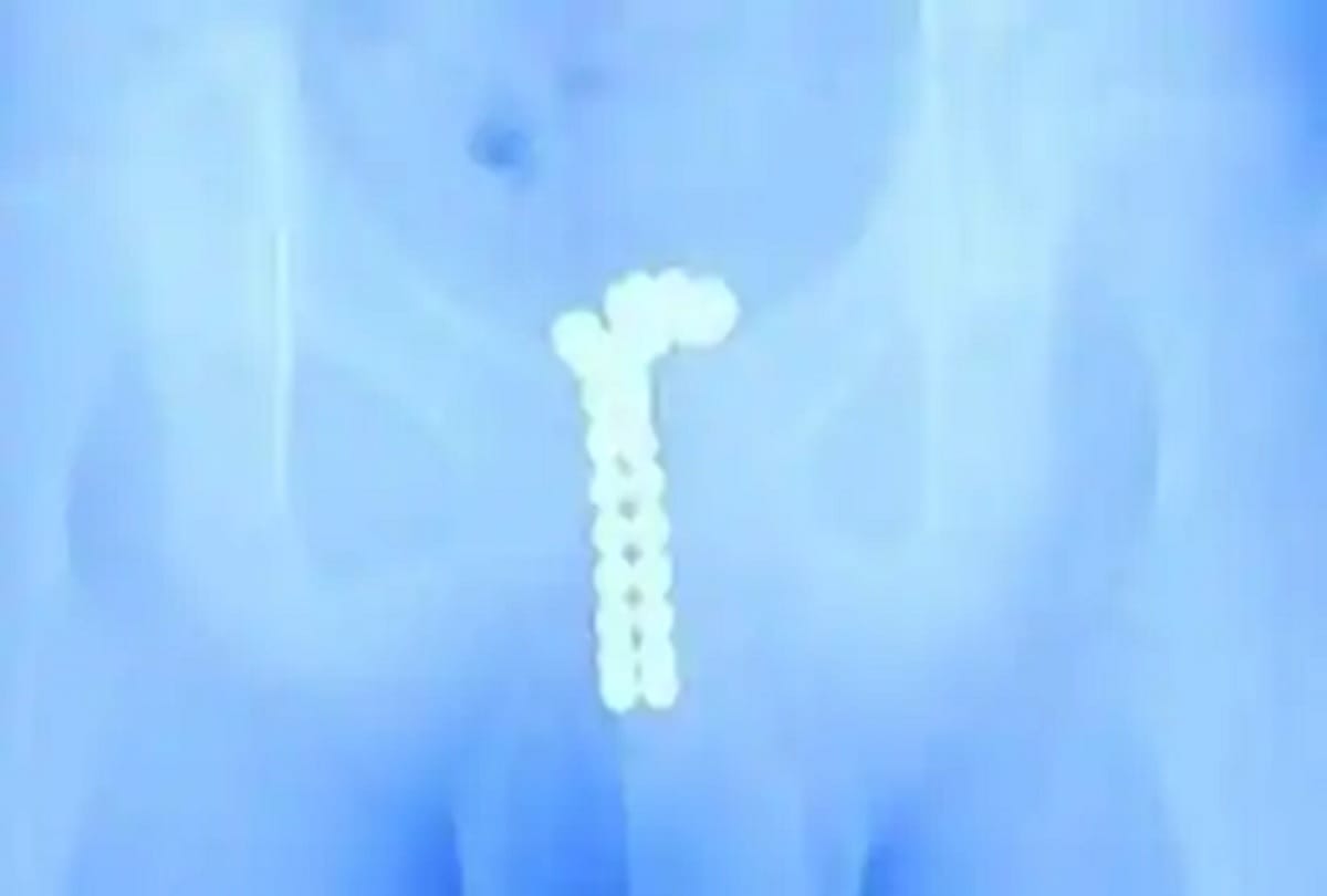 doctor removes 39 magnetic balls from teenager boys private part in china