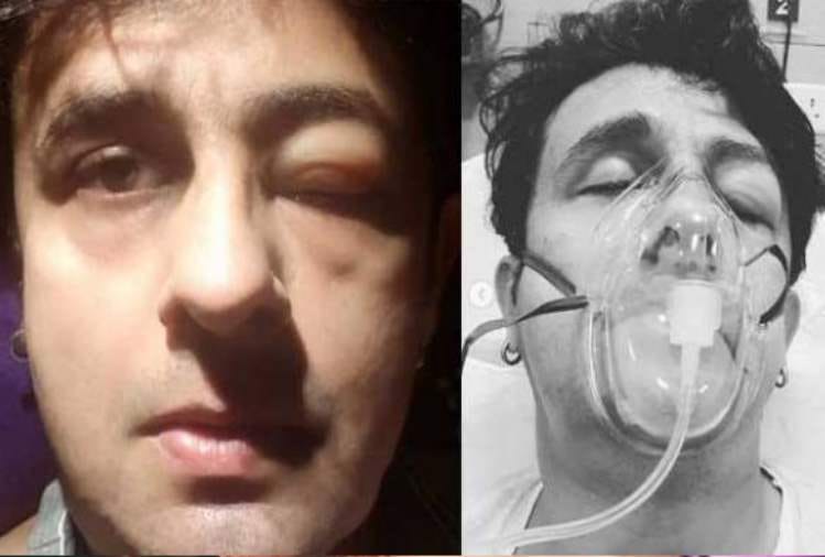 sonu nigam hospitalized share pics with swollen eyes