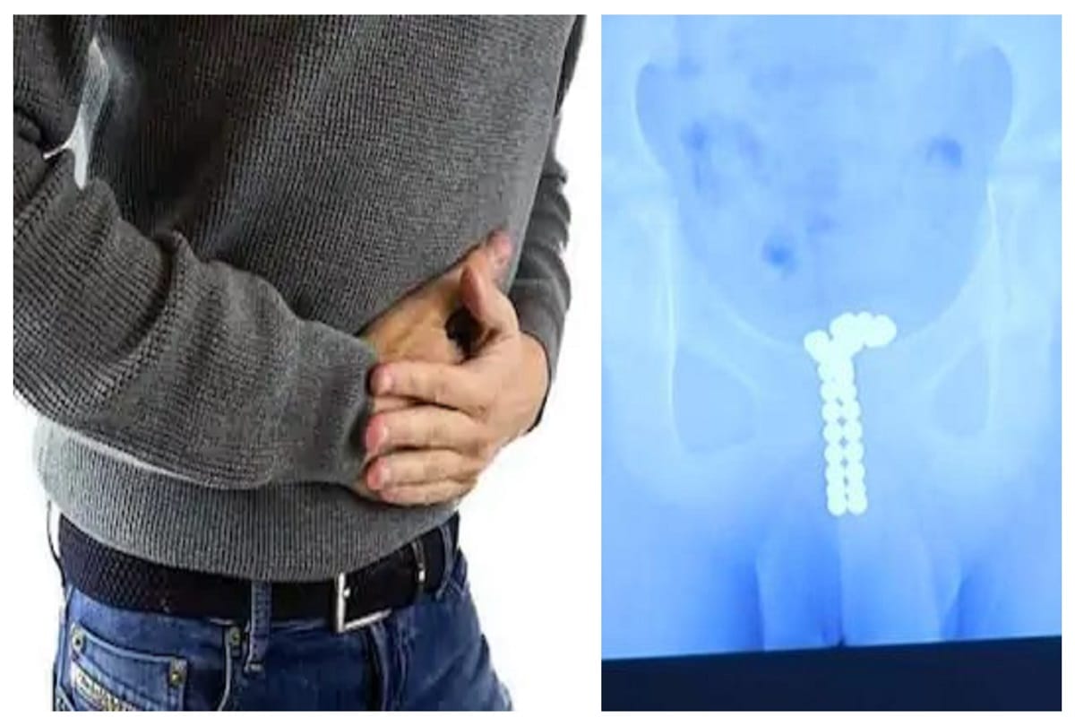 doctor removes 39 magnetic balls from teenager boys private part in china