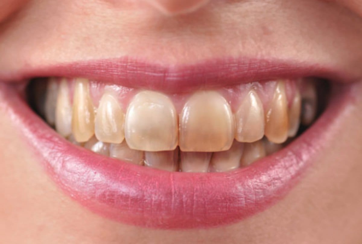 alcohal is not good for teeth