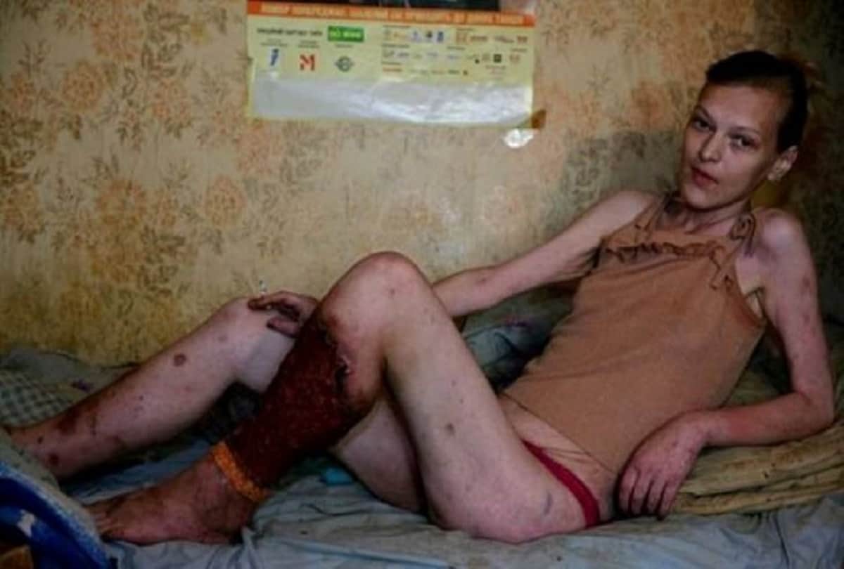 krokodil drug is the deadliest drug in the world which cause a woman rotten her body