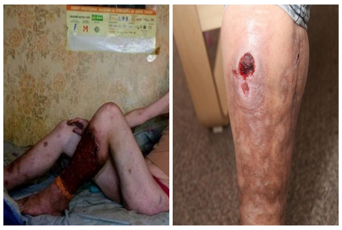 krokodil drug is the deadliest drug in the world which cause a woman rotten her body