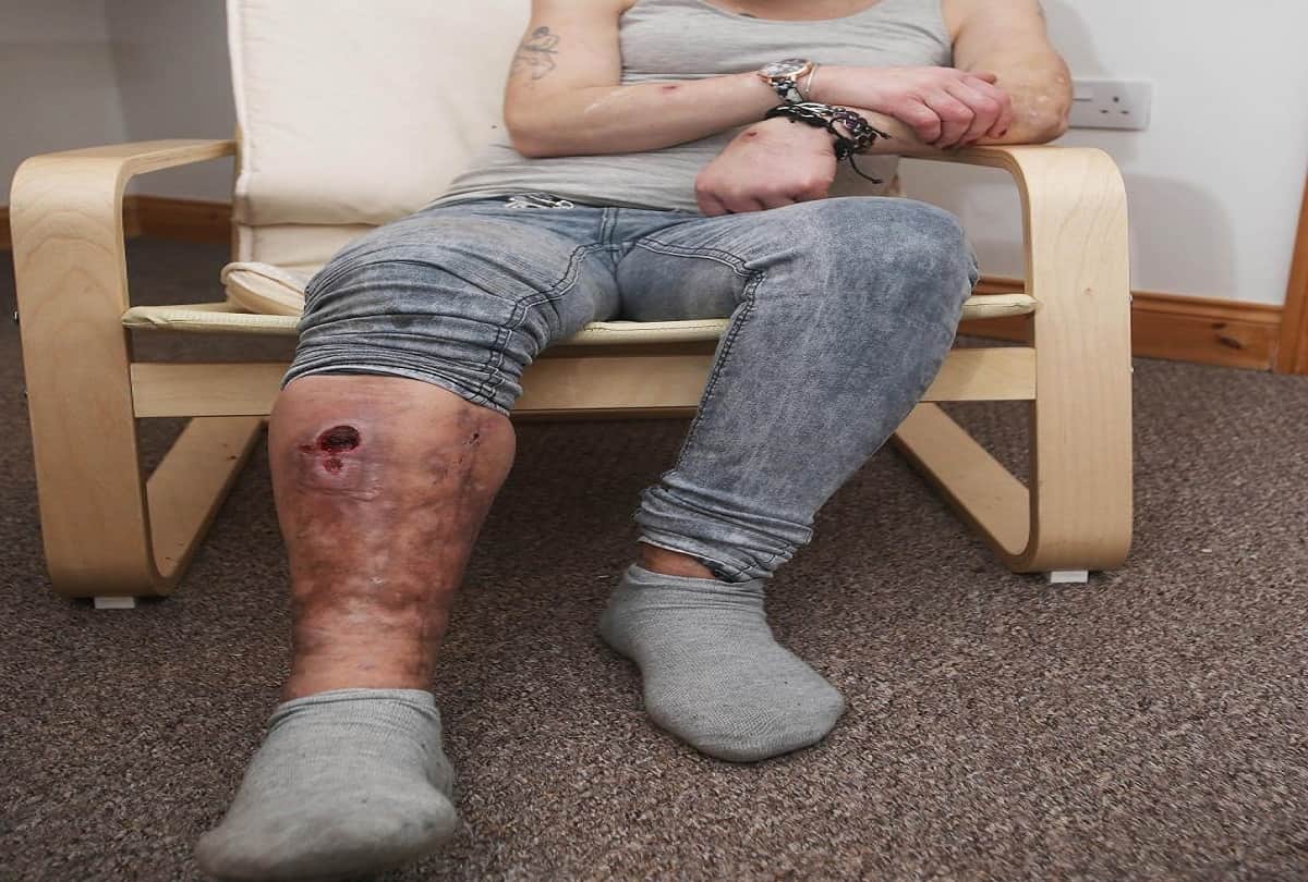 krokodil drug is the deadliest drug in the world which cause a woman rotten her body