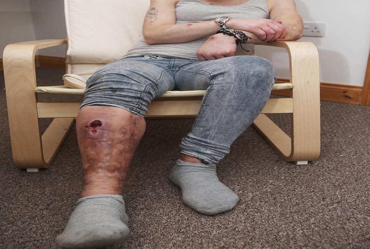 krokodil drug is the deadliest drug in the world which cause a woman rotten her body