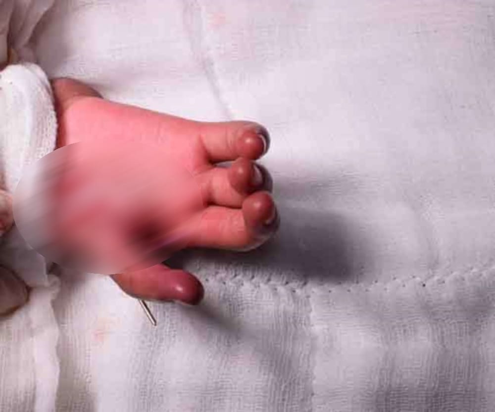baby thumb made from finger in All India Institute of Medical Sciences