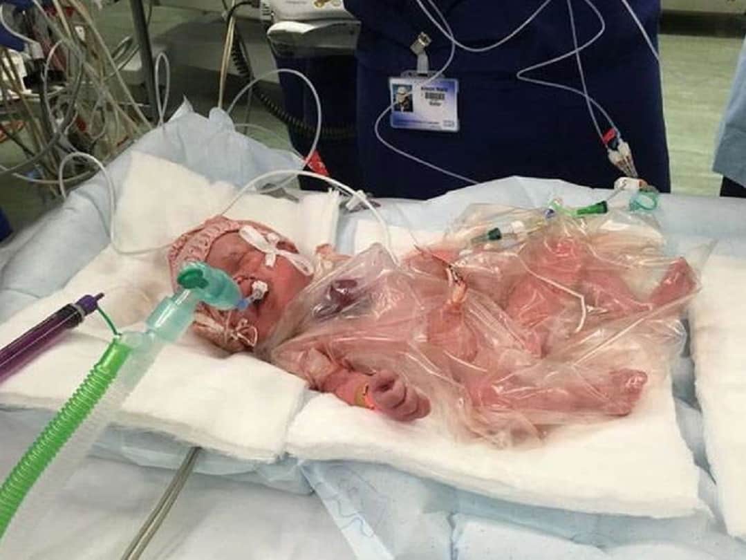 Strange story Miracle baby survives after born with heart outside her body