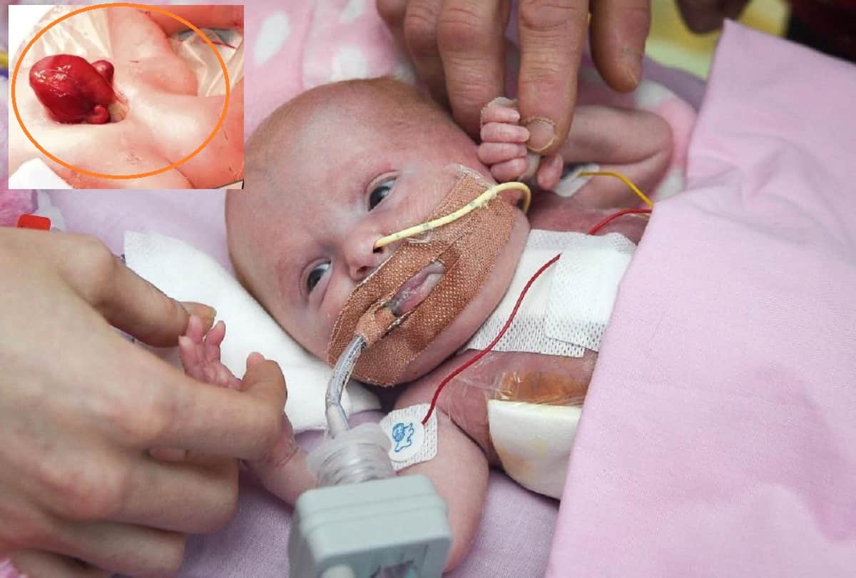 Strange story Miracle baby survives after born with heart outside her body