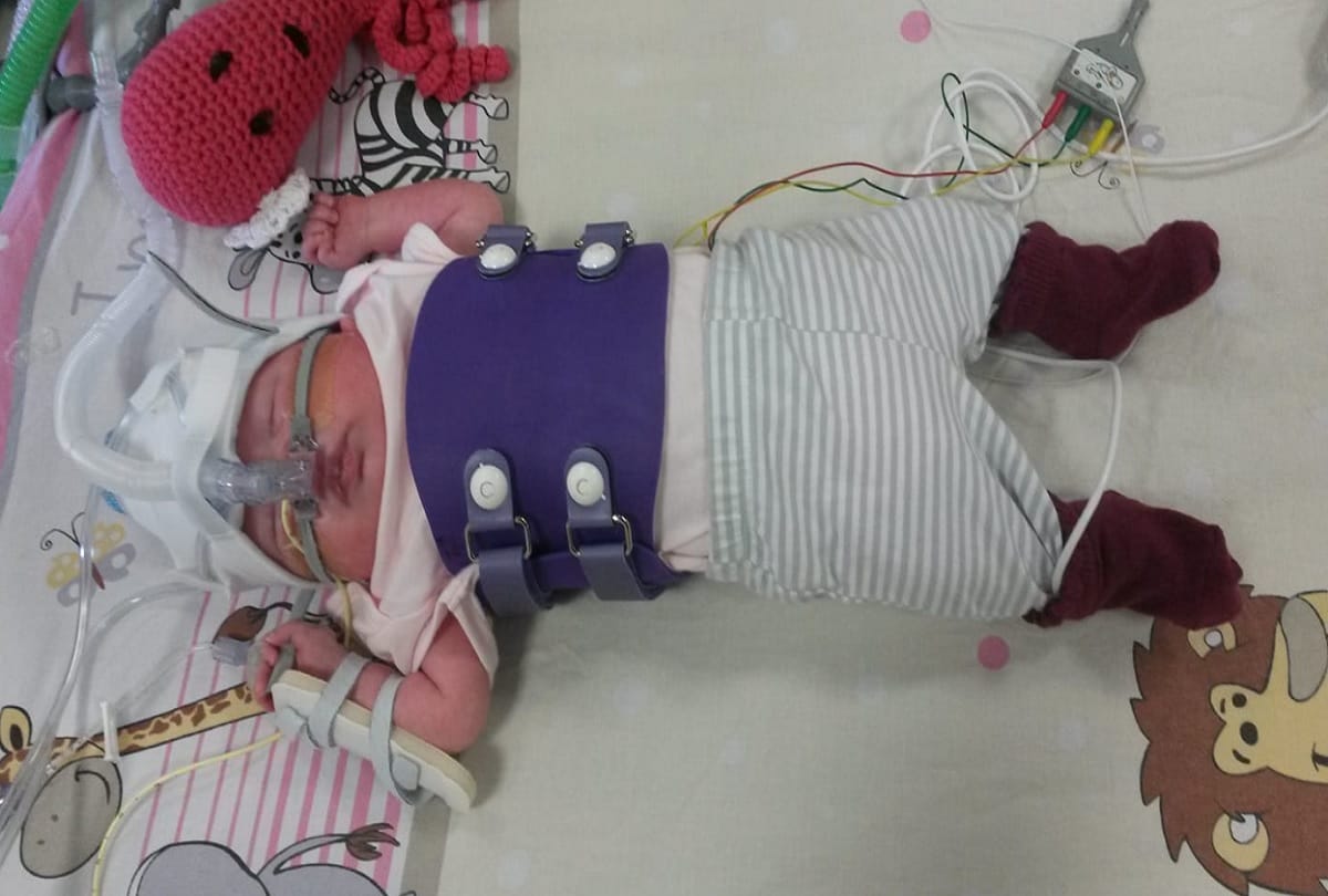 Strange story Miracle baby survives after born with heart outside her body