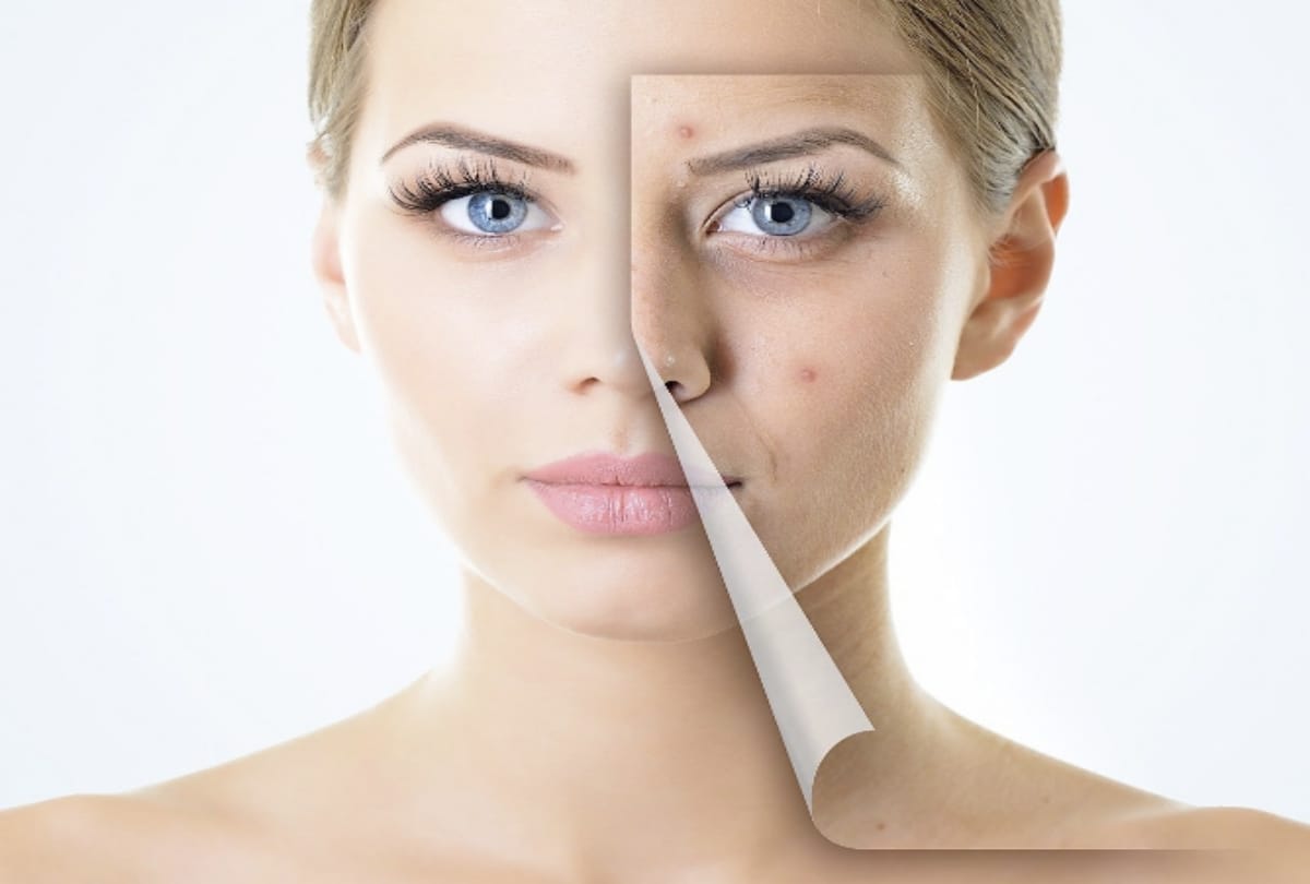 Beauty Tips how to remove pimples at home simple tips in hindi