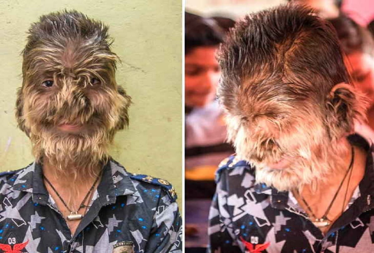 hairs on entire face 13 year old lalit patidar from ratlam madhya pradesh