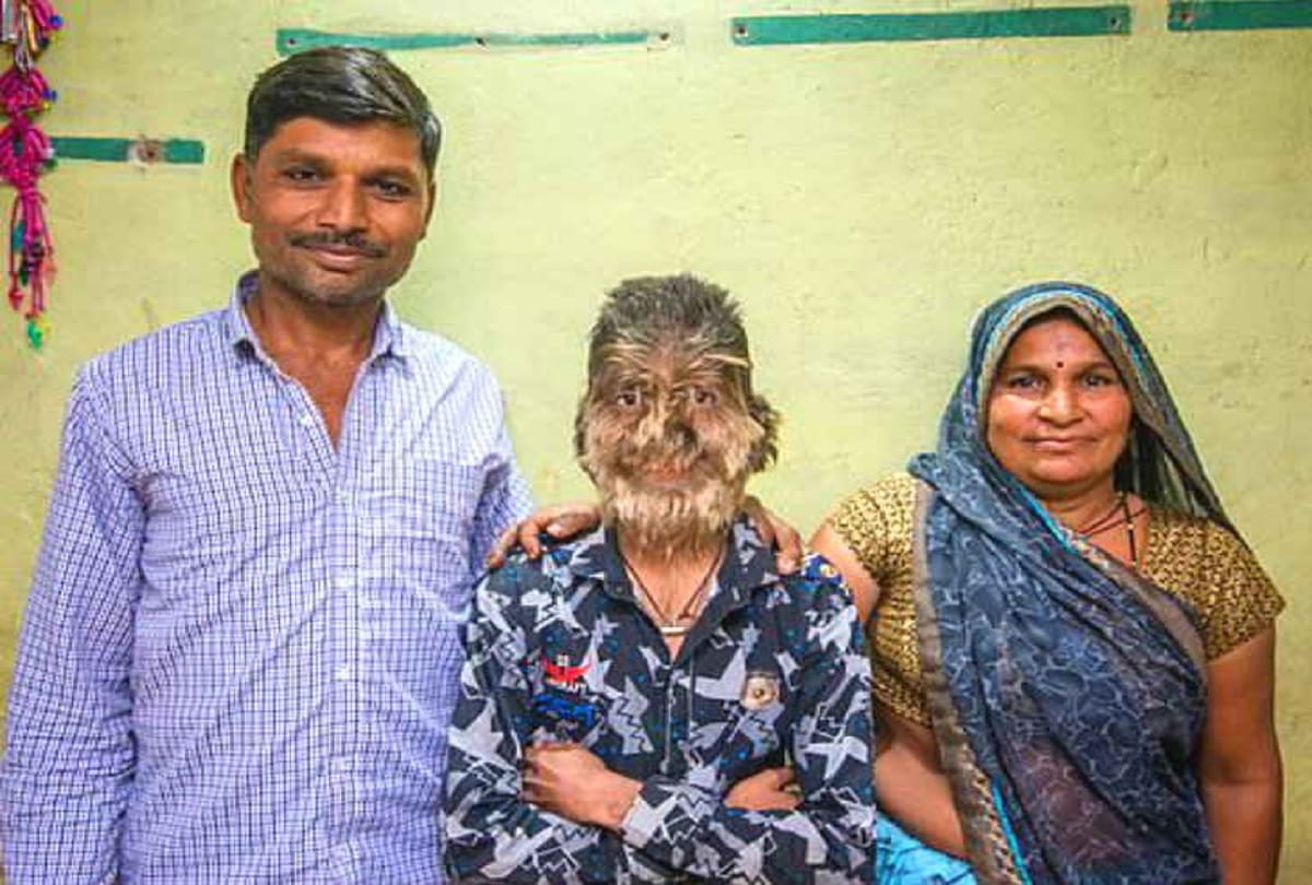 hairs on entire face 13 year old lalit patidar from ratlam madhya pradesh