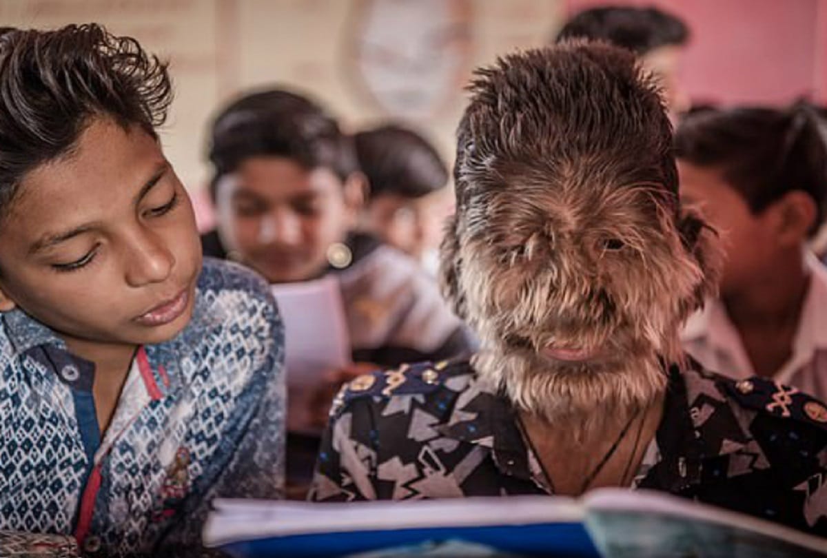 hairs on entire face 13 year old lalit patidar from ratlam madhya pradesh