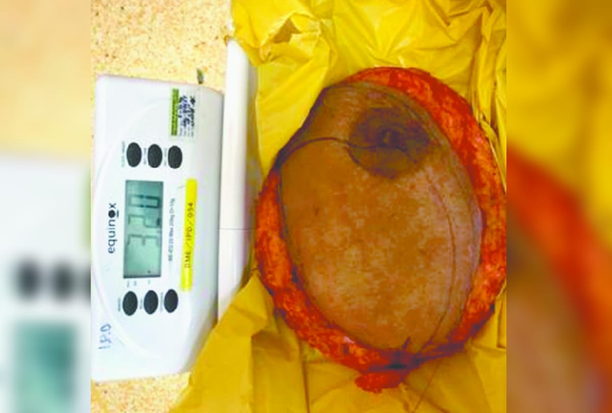 four kg tumor removed from women breast by doctor in Gurugram