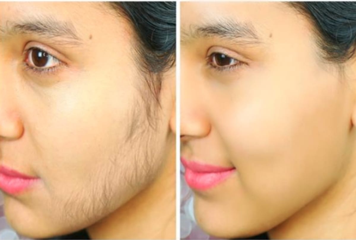know the reason why you are getting hair on your chin
