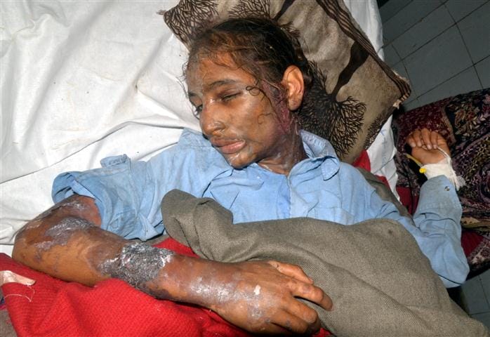 Relatives throw acid on minor sibling