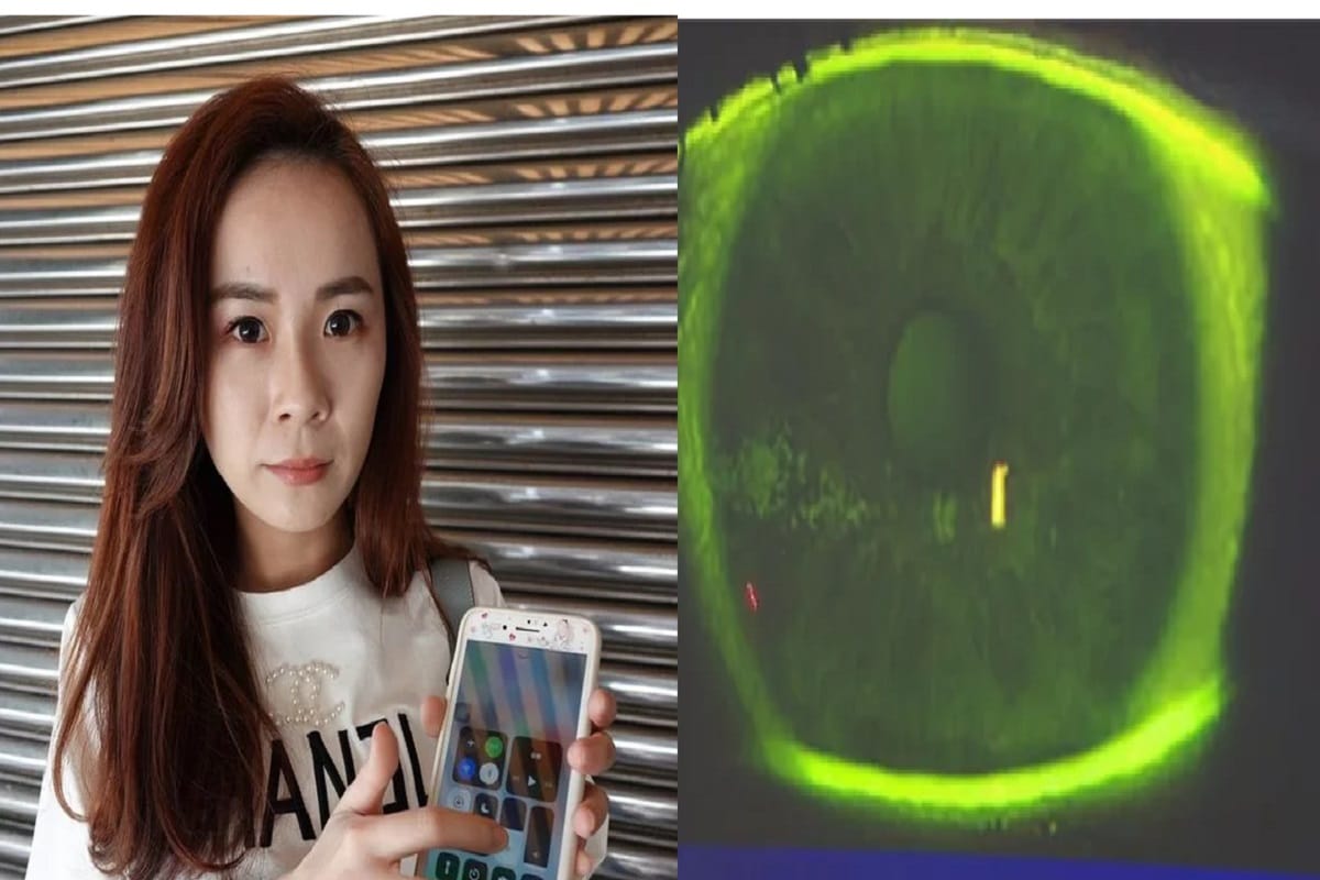 Never use smartphone with full brightness this woman has 500 holes in eye